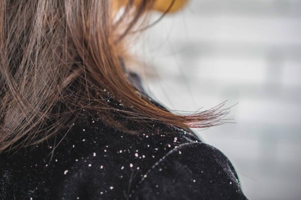 Epsom salt for dandruff 