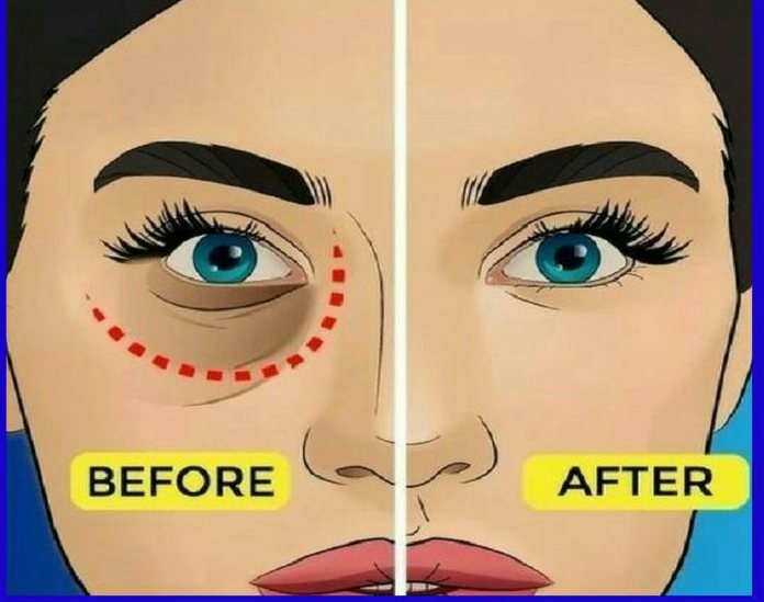 How To Remove Dark Circles With Apple Cider Vinegar Permanently?