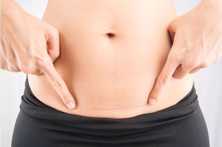 flat tummy after c section