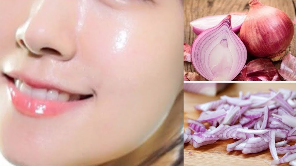 Onion Facial For Acne, Pigmentation & Dull Skin