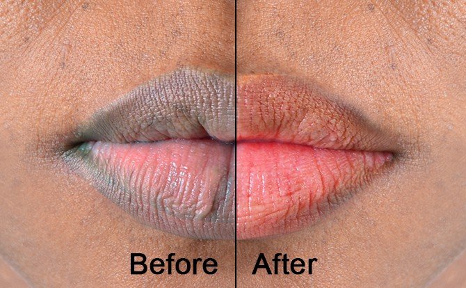 Lighten Lip Pigmentation